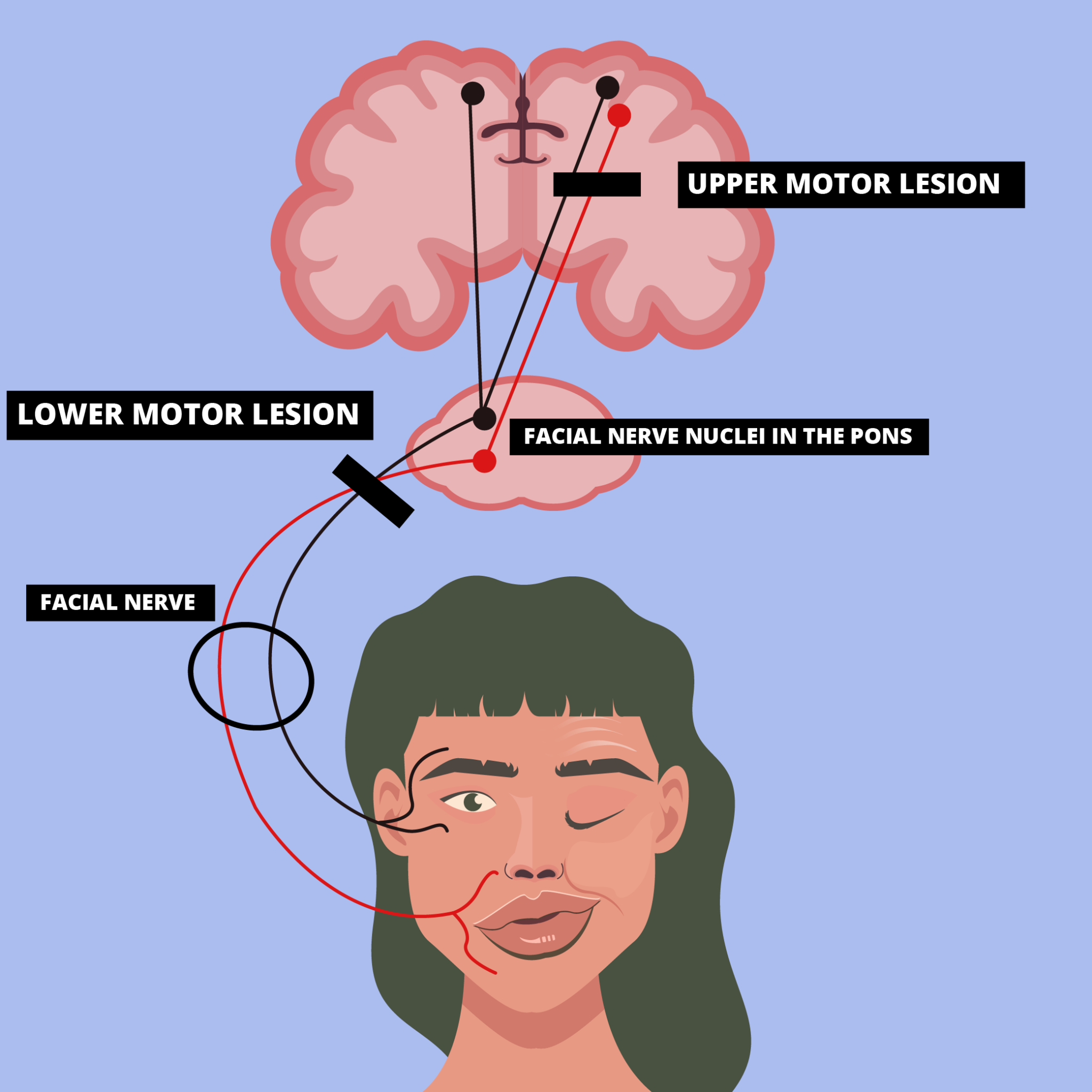 Approach To Facial Nerve Palsy How To Clinically Diagnose Common