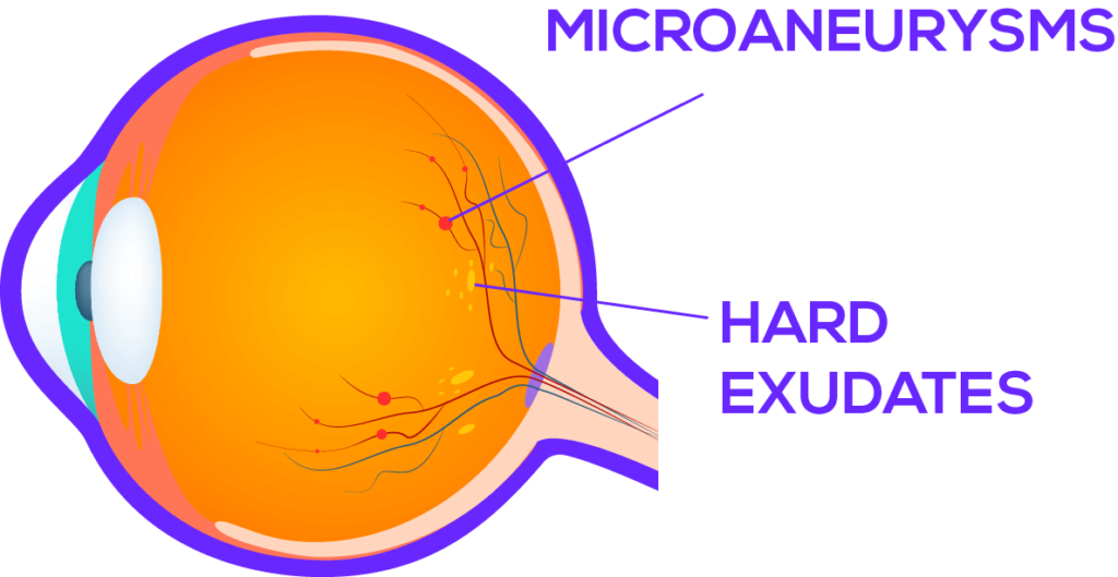 dot and blot hemorrhages causes