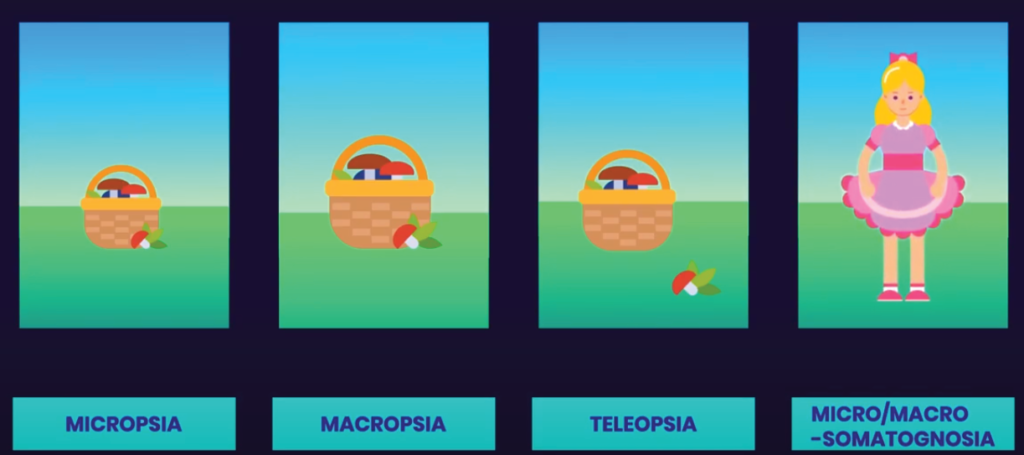 micropsia, macropsia, Teleopsia,, micro-somatognosia, macro-somatognosia