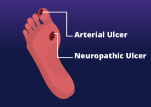 Diabetic Foot Care: Complications & Management - Tiny Medicine