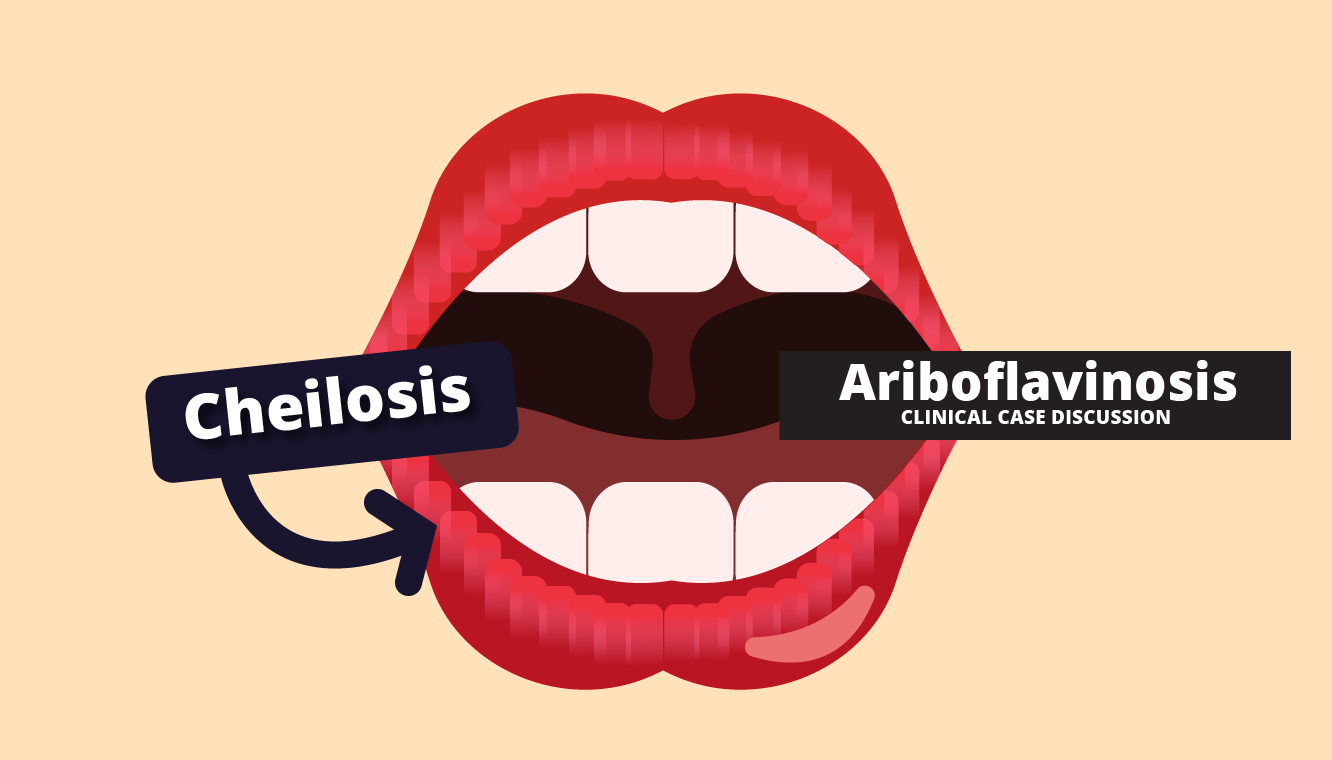 ariboflavinosis cheilosis-01