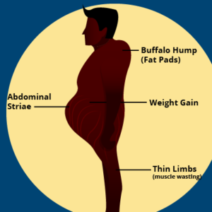 Cushing’s Syndrome – Clinical Case Discussion - Tiny Medicine