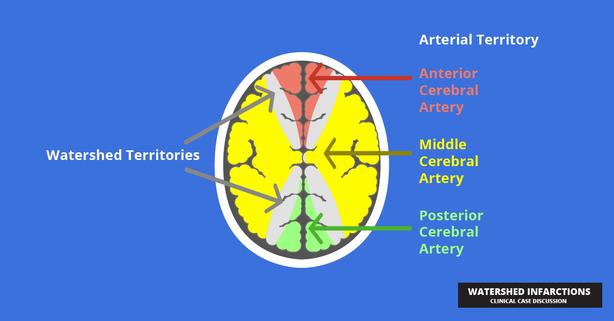 Watershed Infarctions - Clinical Case Discussion - Tiny Medicine