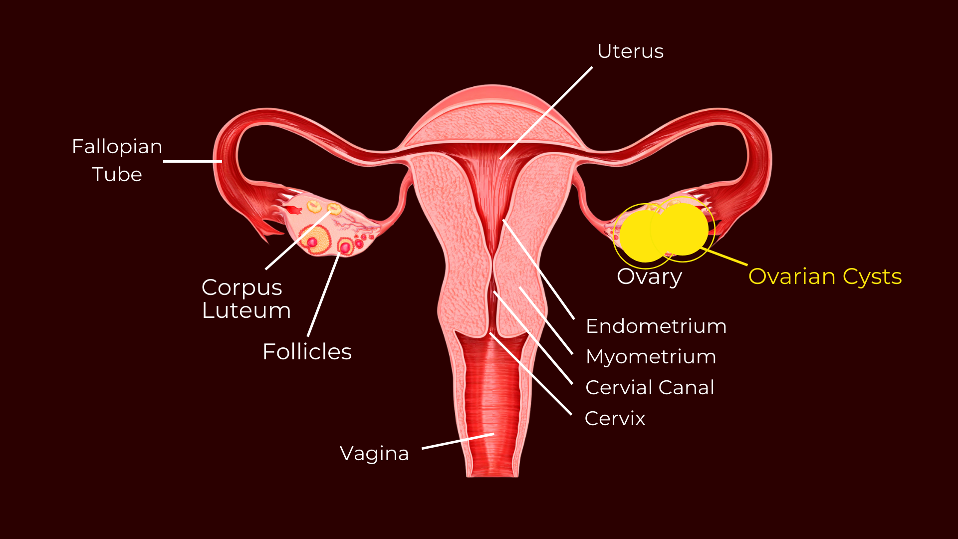 ovarian cysts