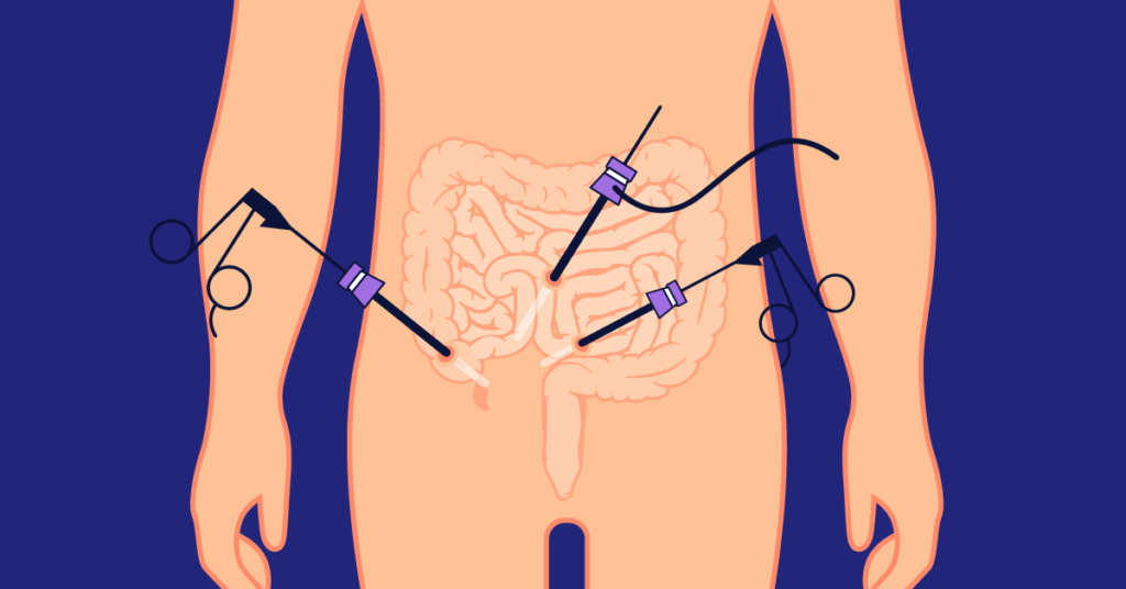 Laparoscopic Appendectomy.  