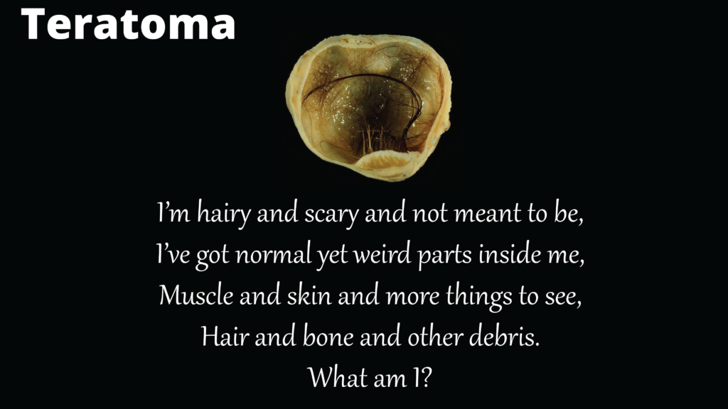 teratoma poem